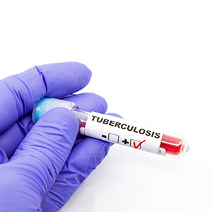 TB Testing Clinic Near Me in Plymouth, MI and Bloomfield Hills, MI